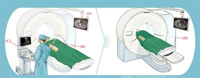 Ultrasound single-phase CBE imaging for monitoring radiofrequency ablation of the liver tumor: A preliminary clinical validation